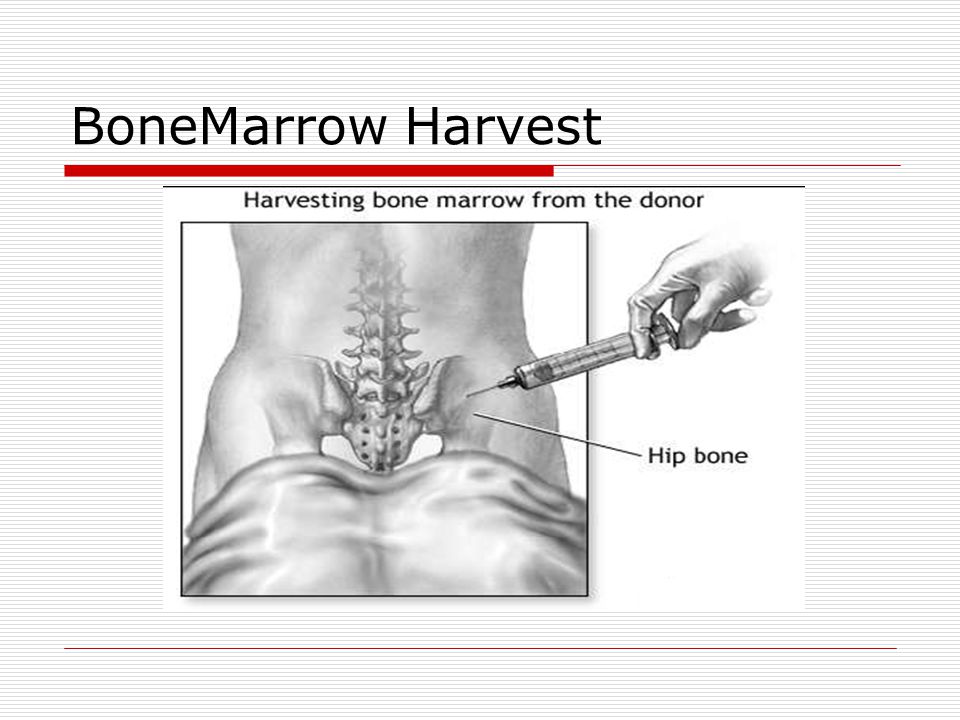 BoneMarrow Harvest
