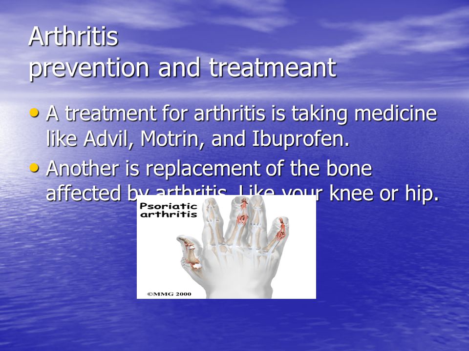 Arthritis prevention and treatmeant A treatment for arthritis is taking medicine like Advil, Motrin, and Ibuprofen.