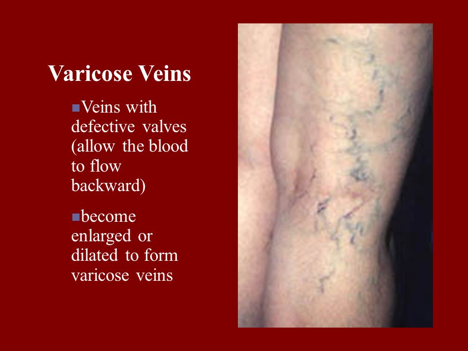 Varicose Veins Veins with defective valves (allow the blood to flow backward) become enlarged or dilated to form varicose veins