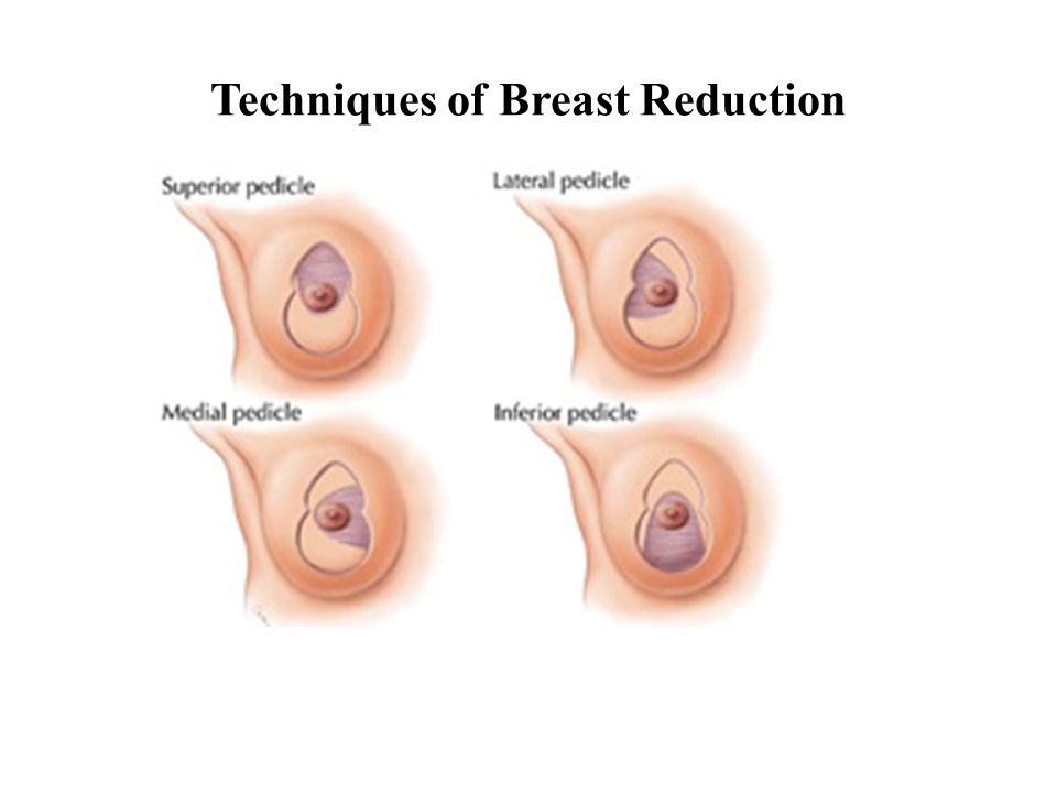 can you breast feed after breast reduction surgery Can you breast feed after breast reduction surgery