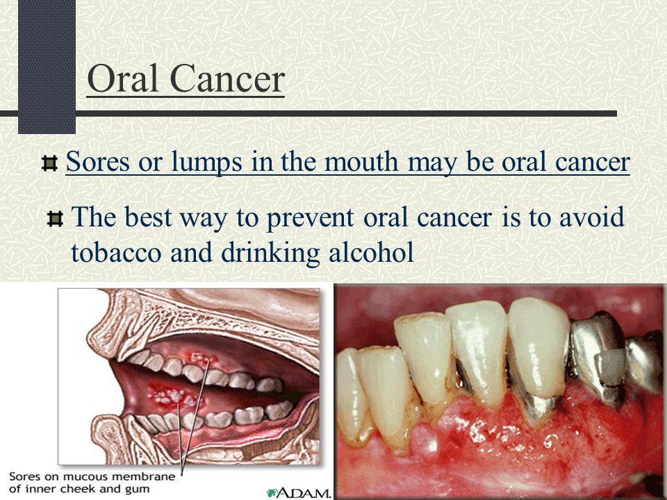 Oral Cancer Sores or lumps in the mouth may be oral cancer The best way to prevent oral cancer is to avoid tobacco and drinking alcohol