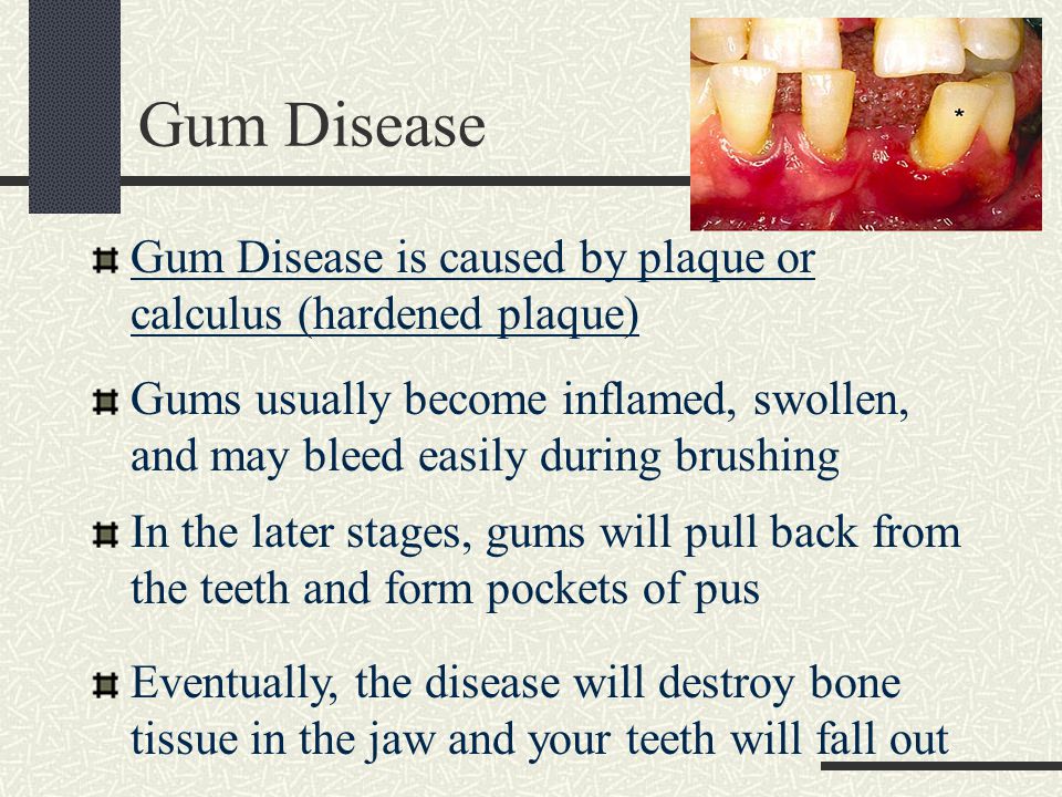 Gum Disease Gum Disease is caused by plaque or calculus (hardened plaque) Gums usually become inflamed, swollen, and may bleed easily during brushing In the later stages, gums will pull back from the teeth and form pockets of pus Eventually, the disease will destroy bone tissue in the jaw and your teeth will fall out