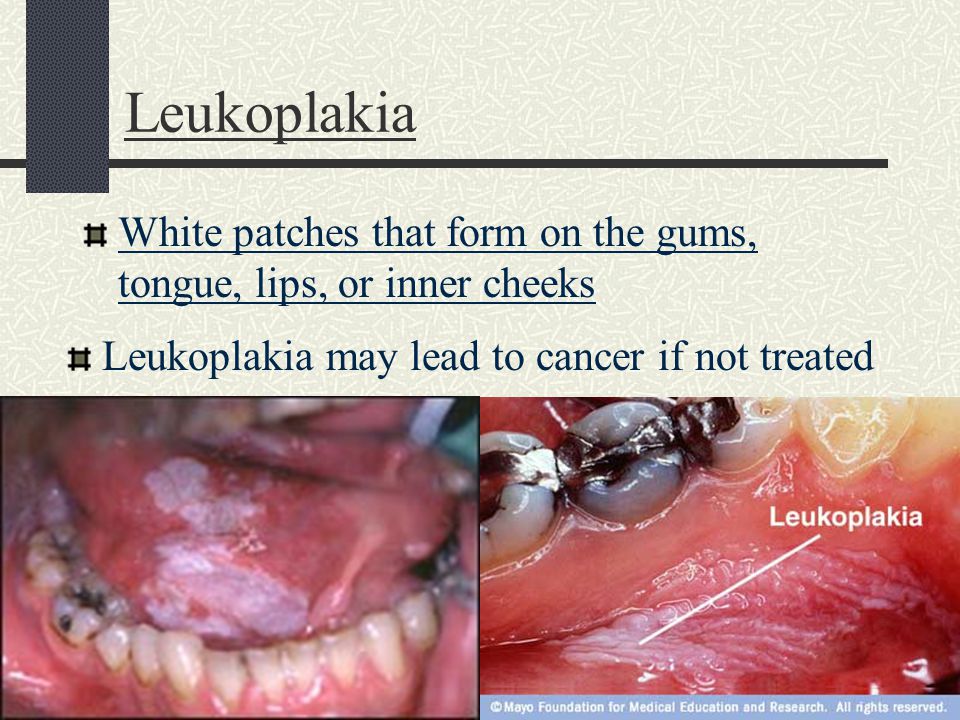Leukoplakia White patches that form on the gums, tongue, lips, or inner cheeks Leukoplakia may lead to cancer if not treated