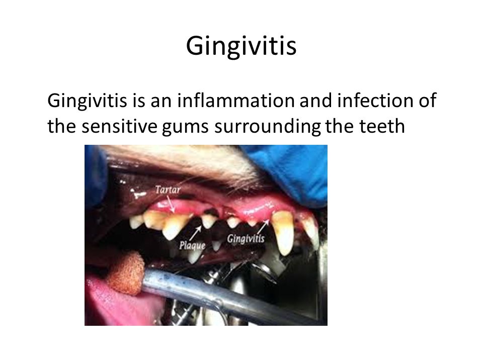 Gingivitis Gingivitis is an inflammation and infection of the sensitive gums surrounding the teeth