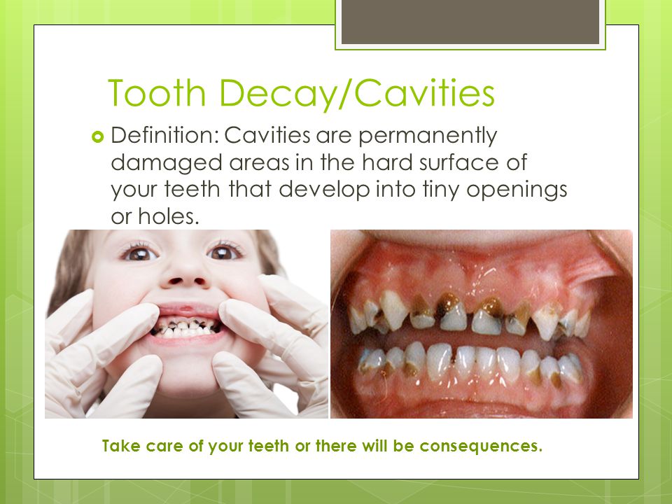Tooth Decay/Cavities  Definition: Cavities are permanently damaged areas in the hard surface of your teeth that develop into tiny openings or holes.
