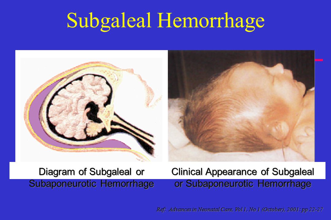 Subaponeurotic hemorrhage
