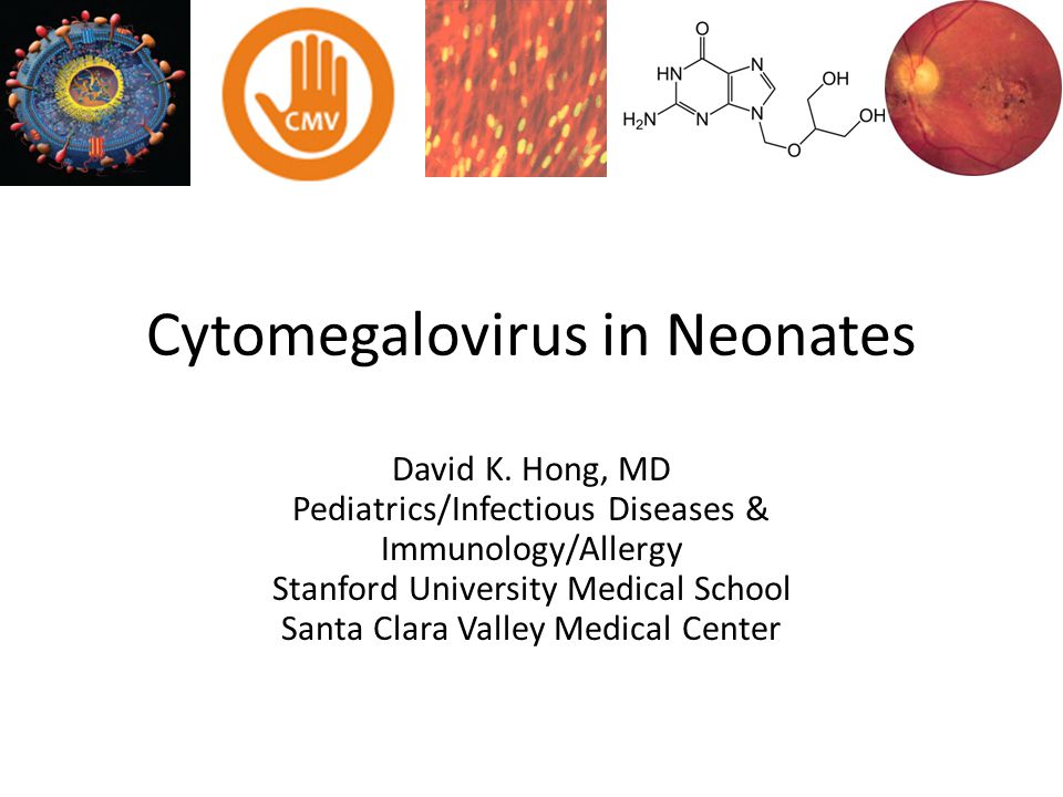 Cytomegalovirus in Neonates David K.