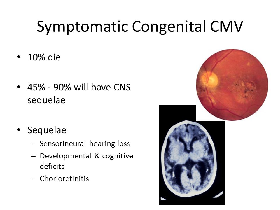 Symptomatic Congenital CMV 10% die 45% - 90% will have CNS sequelae Sequelae – Sensorineural hearing loss – Developmental & cognitive deficits – Chorioretinitis