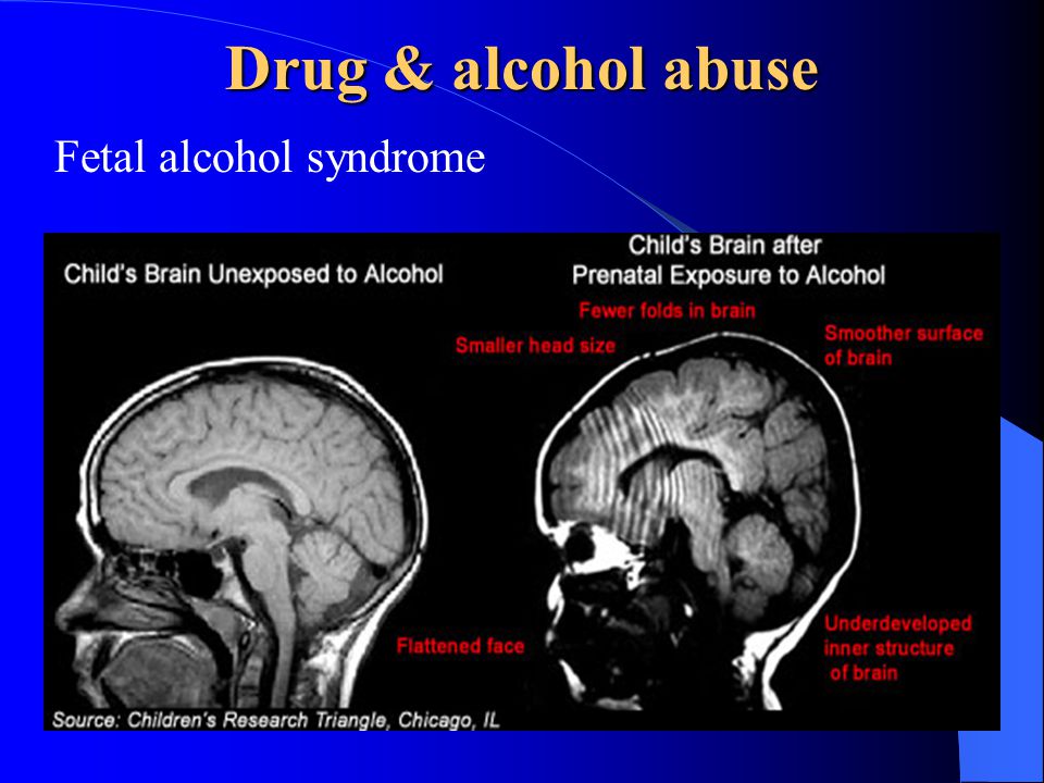 After brain. Alcohol Damage to the Brain.