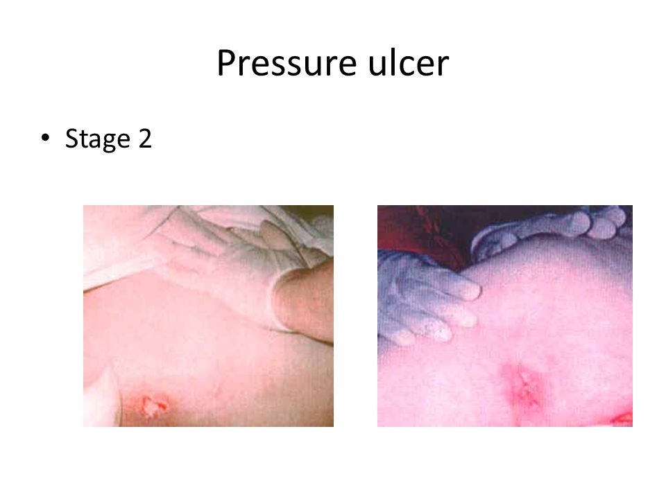 Pressure ulcer Stage 2