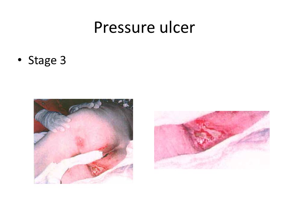 Pressure ulcer Stage 3