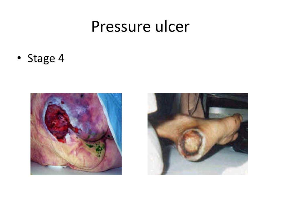 Pressure ulcer Stage 4