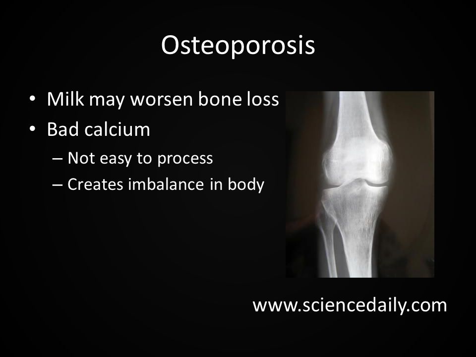 Osteoporosis Milk may worsen bone loss Bad calcium – Not easy to process – Creates imbalance in body