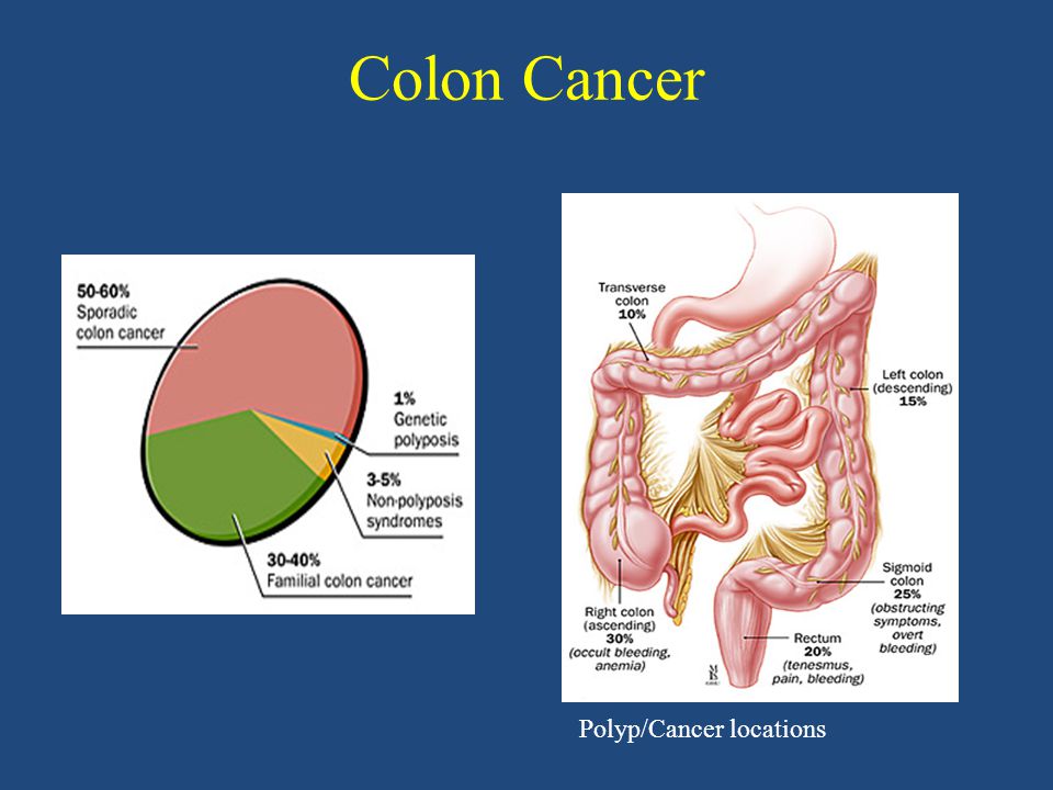 Colon Cancer Polyp/Cancer locations
