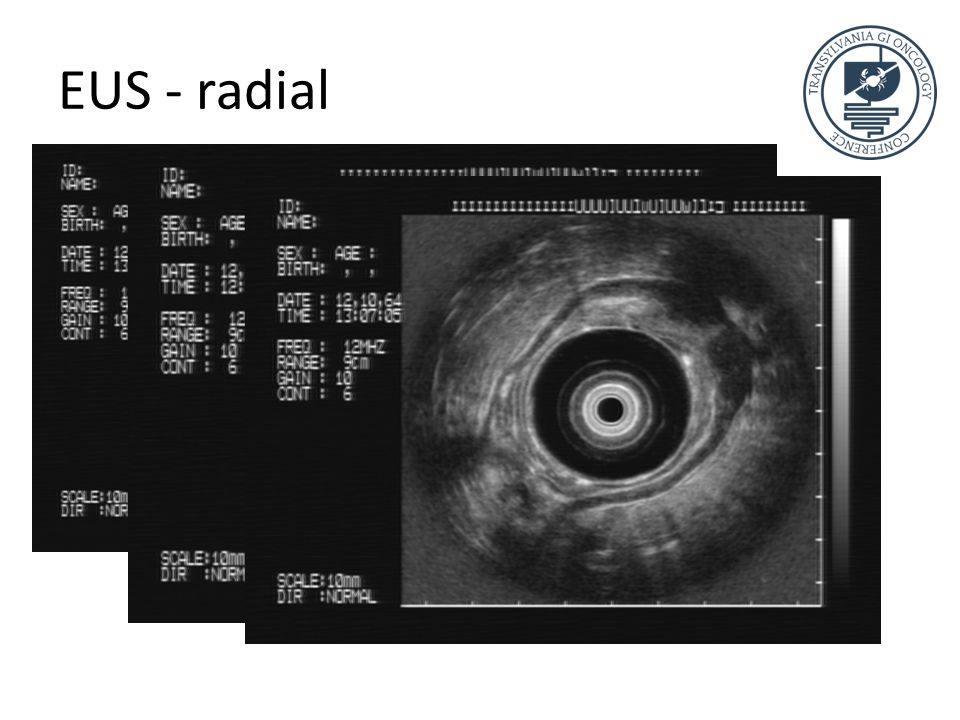 EUS - radial