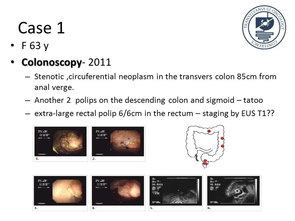 Case 1 F 63 y Colonoscopy Colonoscopy – Stenotic,circuferential neoplasm in the transvers colon 85cm from anal verge.