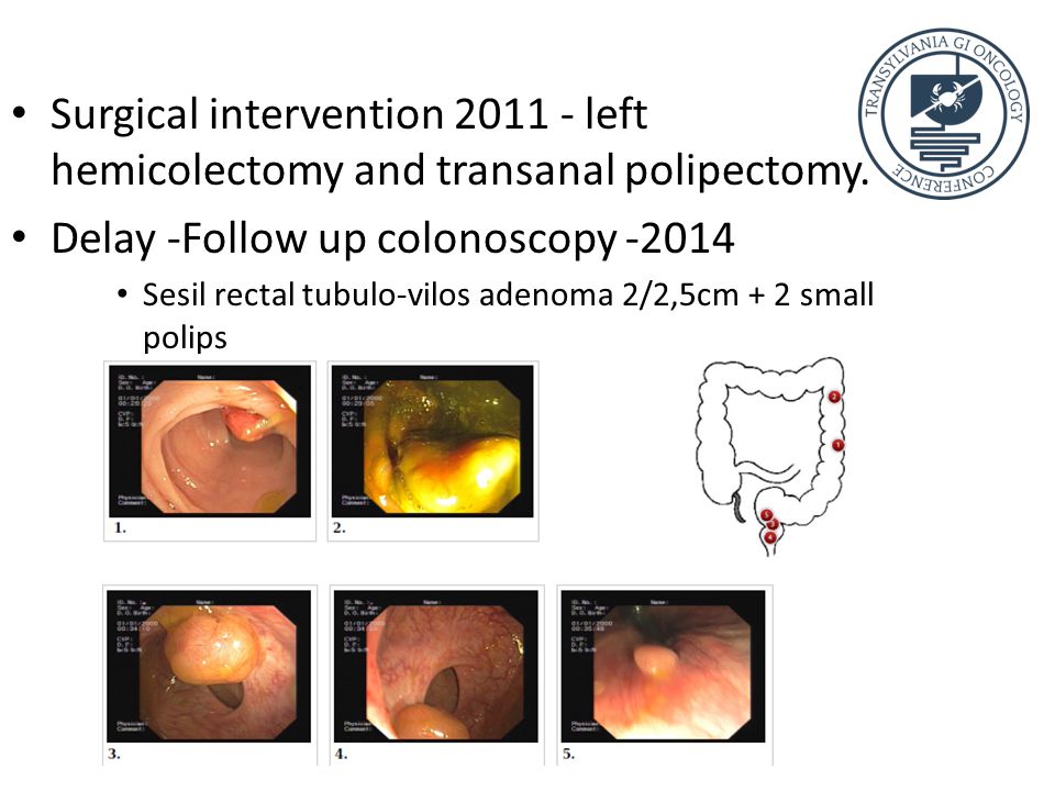 Surgical intervention left hemicolectomy and transanal polipectomy.