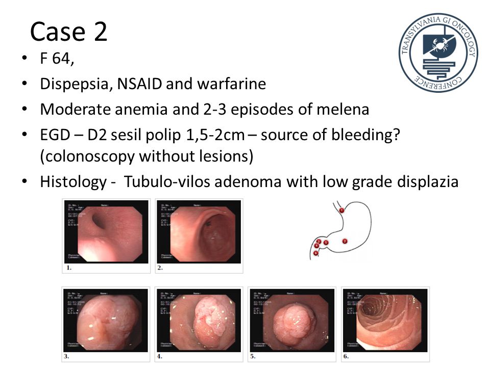 Case 2 F 64, Dispepsia, NSAID and warfarine Moderate anemia and 2-3 episodes of melena EGD – D2 sesil polip 1,5-2cm – source of bleeding.