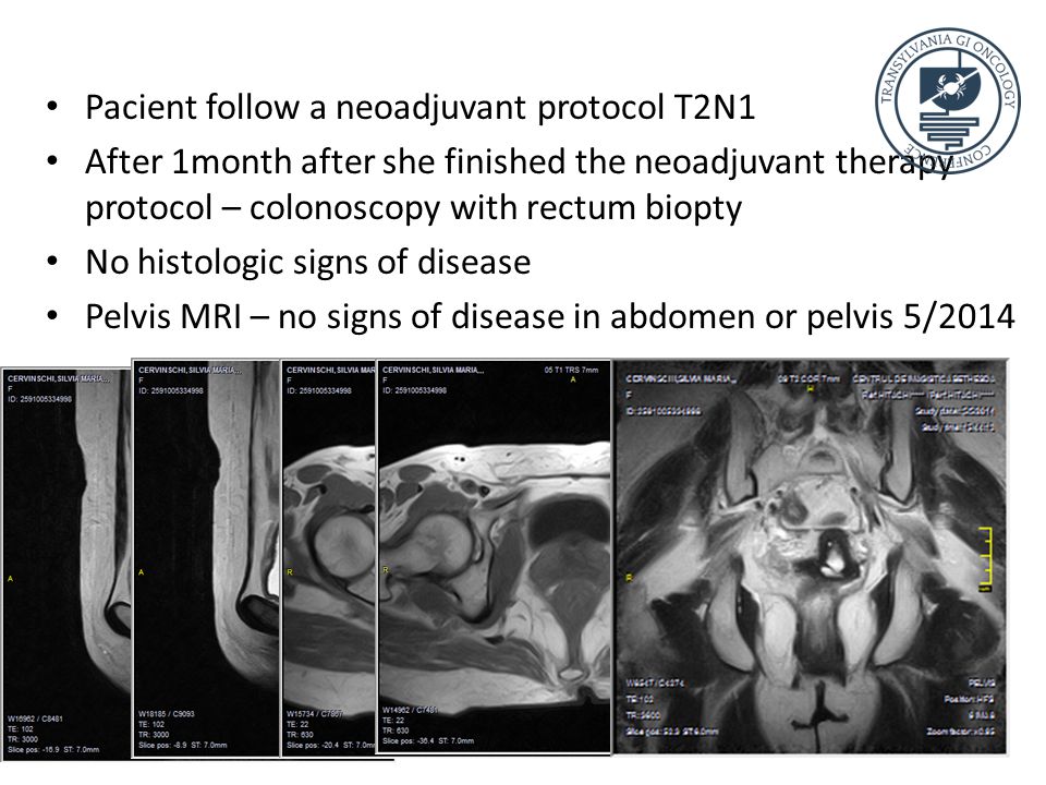 Pacient follow a neoadjuvant protocol T2N1 After 1month after she finished the neoadjuvant therapy protocol – colonoscopy with rectum biopty No histologic signs of disease Pelvis MRI – no signs of disease in abdomen or pelvis 5/2014