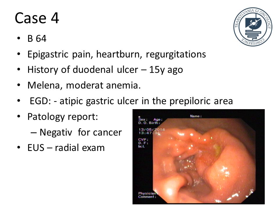 Case 4 B 64 Epigastric pain, heartburn, regurgitations History of duodenal ulcer – 15y ago Melena, moderat anemia.