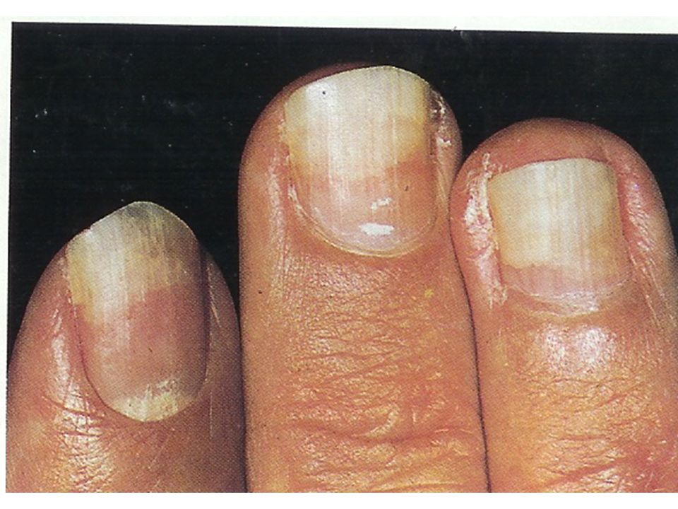 FINGERNAILS AND WHAT THEY REVEAL By Gabrielle Traub Homeopathy 4 Everyone –  January ppt download