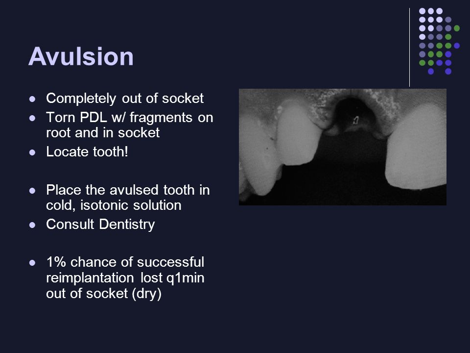 Avulsion Completely out of socket Torn PDL w/ fragments on root and in socket Locate tooth.