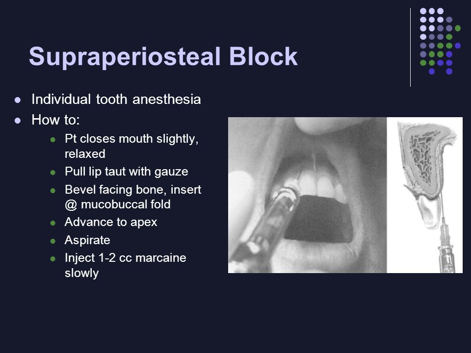 Supraperiosteal Block Individual tooth anesthesia How to: Pt closes mouth slightly, relaxed Pull lip taut with gauze Bevel facing bone, mucobuccal fold Advance to apex Aspirate Inject 1-2 cc marcaine slowly