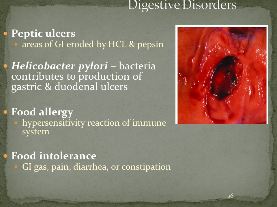 16 Peptic ulcers areas of GI eroded by HCL & pepsin Helicobacter pylori – bacteria contributes to production of gastric & duodenal ulcers Food allergy hypersensitivity reaction of immune system Food intolerance GI gas, pain, diarrhea, or constipation