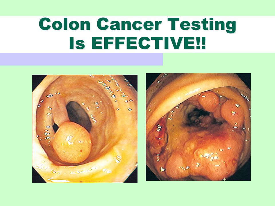 Colon Cancer Testing Is EFFECTIVE!!