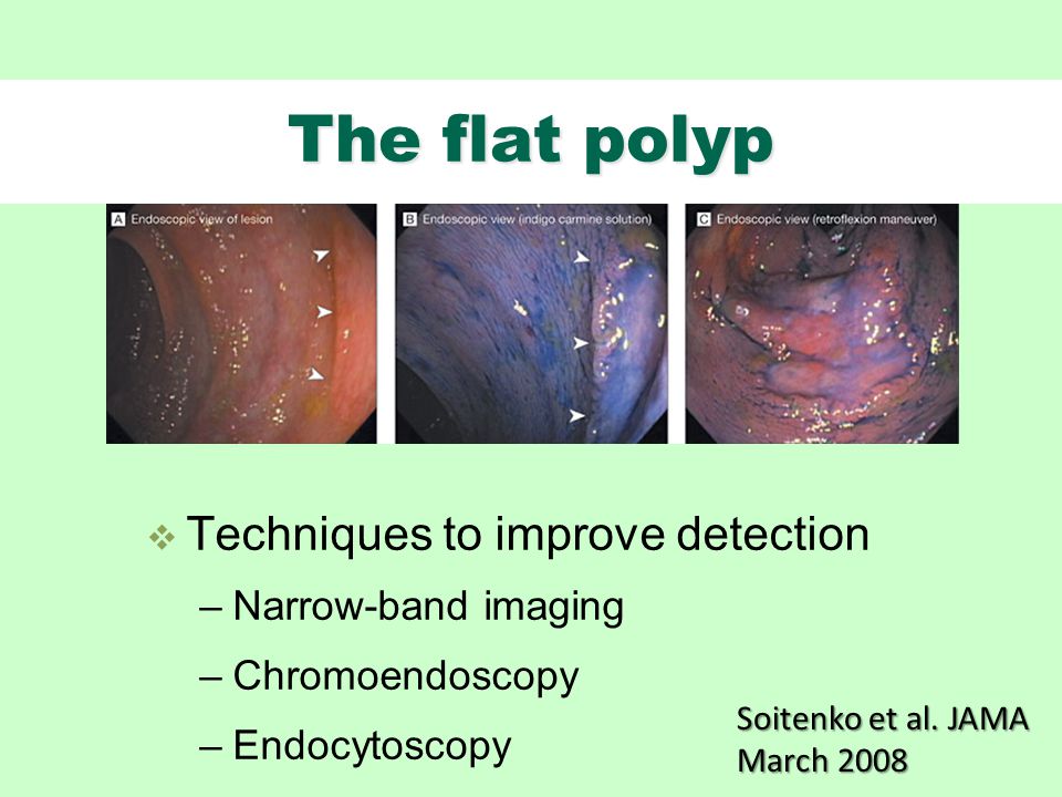 The flat polyp  Techniques to improve detection –Narrow-band imaging –Chromoendoscopy –Endocytoscopy Soitenko et al.