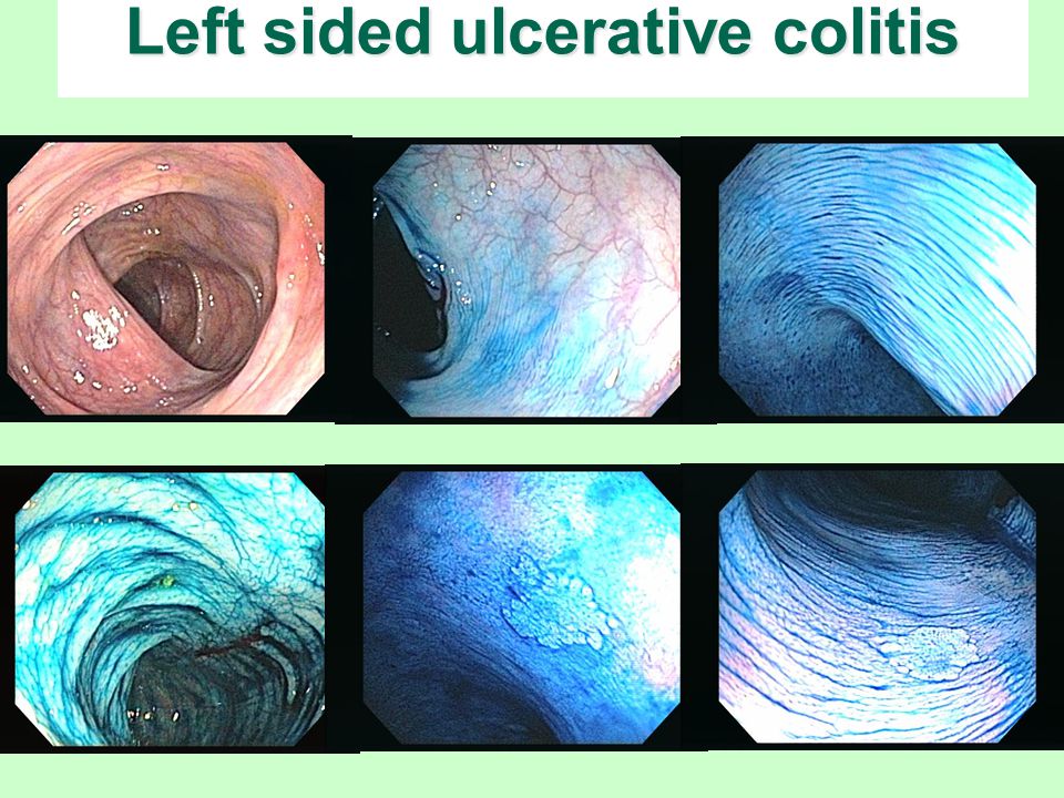 Left sided ulcerative colitis