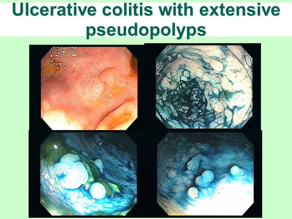 Ulcerative colitis with extensive pseudopolyps