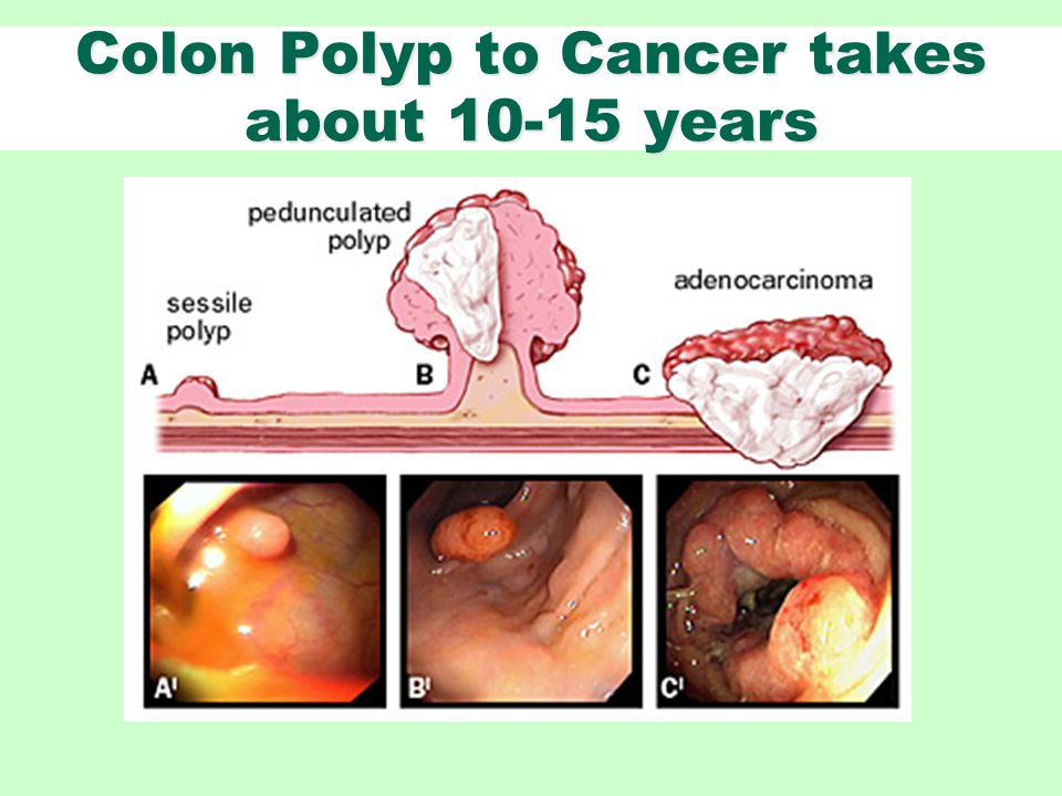 Colon Polyp to Cancer takes about years