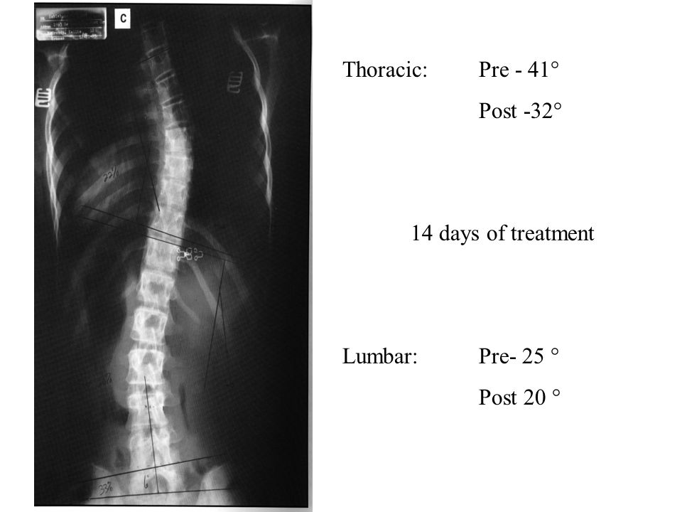 Thoracic: Pre - 41° Post -32° 14 days of treatment Lumbar: Pre- 25 ° Post 20 °
