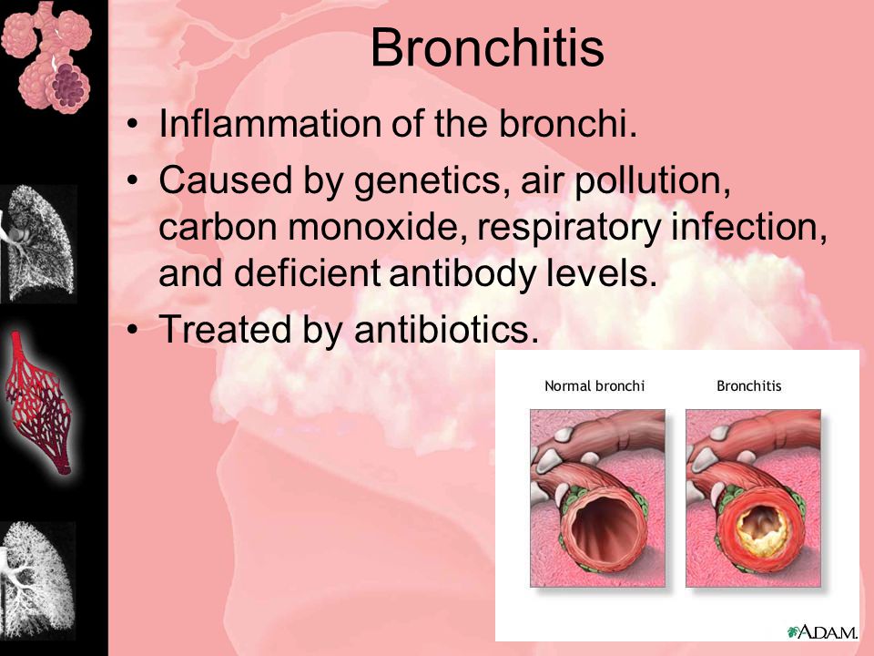 Bronchitis Inflammation of the bronchi.