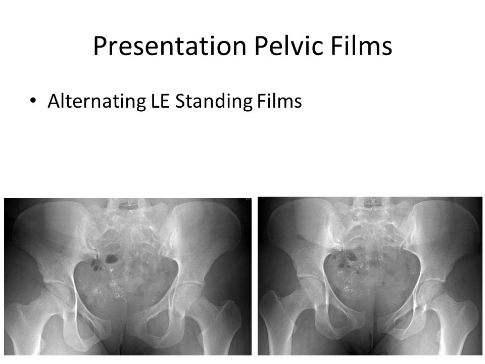 Presentation Pelvic Films Alternating LE Standing Films