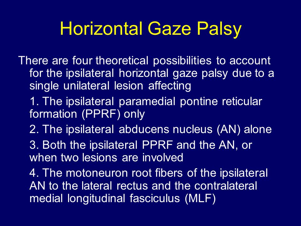 Horizontal gaze palsy