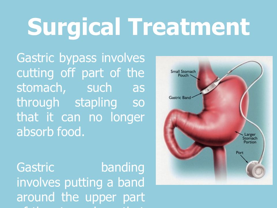 Surgical Treatment Gastric bypass involves cutting off part of the stomach, such as through stapling so that it can no longer absorb food.