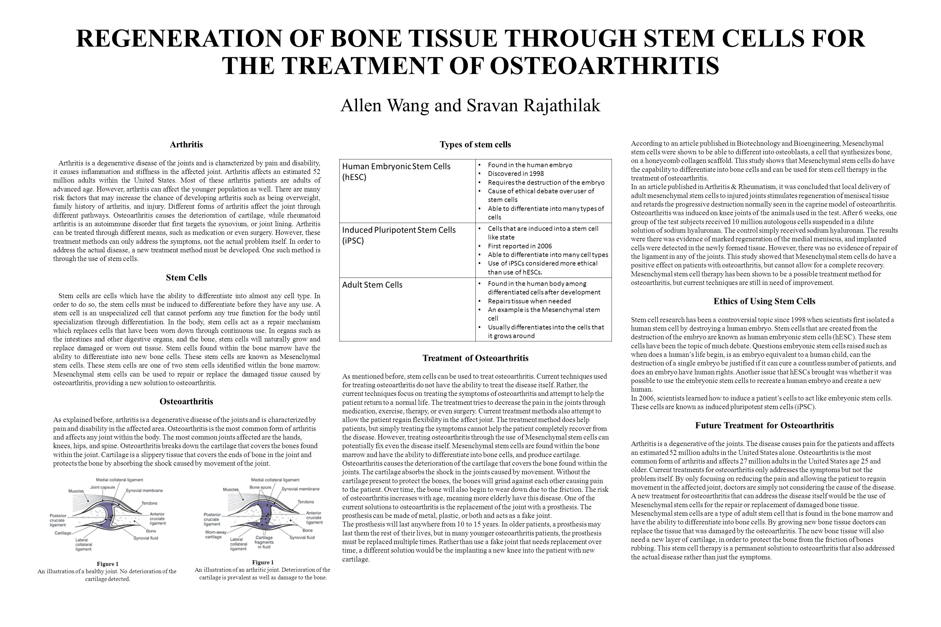 REGENERATION OF BONE TISSUE THROUGH STEM CELLS FOR THE TREATMENT OF OSTEOARTHRITIS Allen Wang and Sravan Rajathilak Arthritis Arthritis is a degenerative disease of the joints and is characterized by pain and disability, it causes inflammation and stiffness in the affected joint.