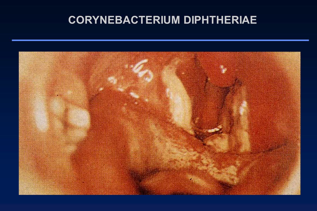 CORYNEBACTERIUM DIPHTHERIAE