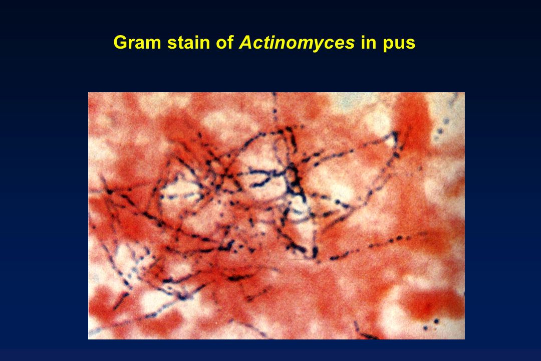 Gram stain of Actinomyces in pus