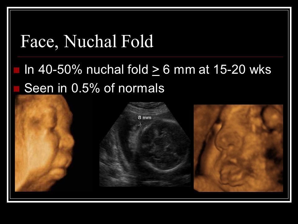 Translucency nuchal nuchal fold vs Second Trimester