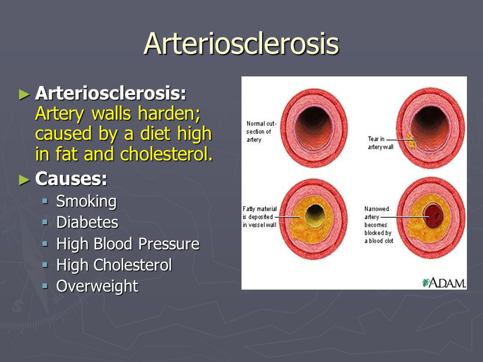 Arteriosclerosis ► Arteriosclerosis: Artery walls harden; caused by a diet high in fat and cholesterol.