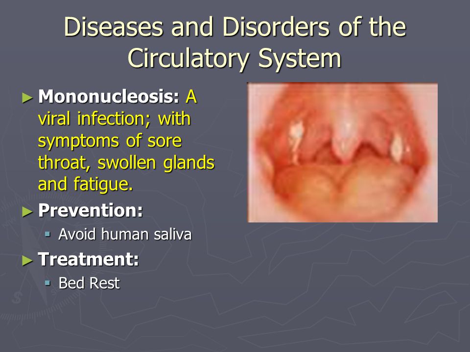 Diseases and Disorders of the Circulatory System ► Mononucleosis: A viral infection; with symptoms of sore throat, swollen glands and fatigue.