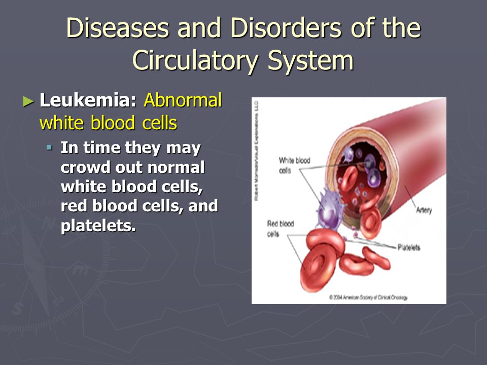 Diseases and Disorders of the Circulatory System ► Leukemia: Abnormal white blood cells  In time they may crowd out normal white blood cells, red blood cells, and platelets.