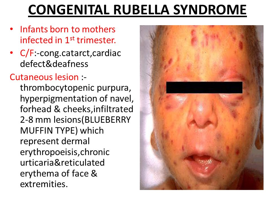 Dermal Manifestations In Viral Diseases In Children Dr Binod Kumar 