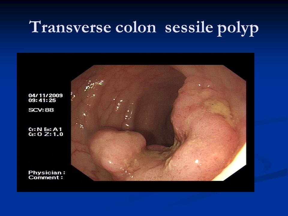 Transverse colon sessile polyp