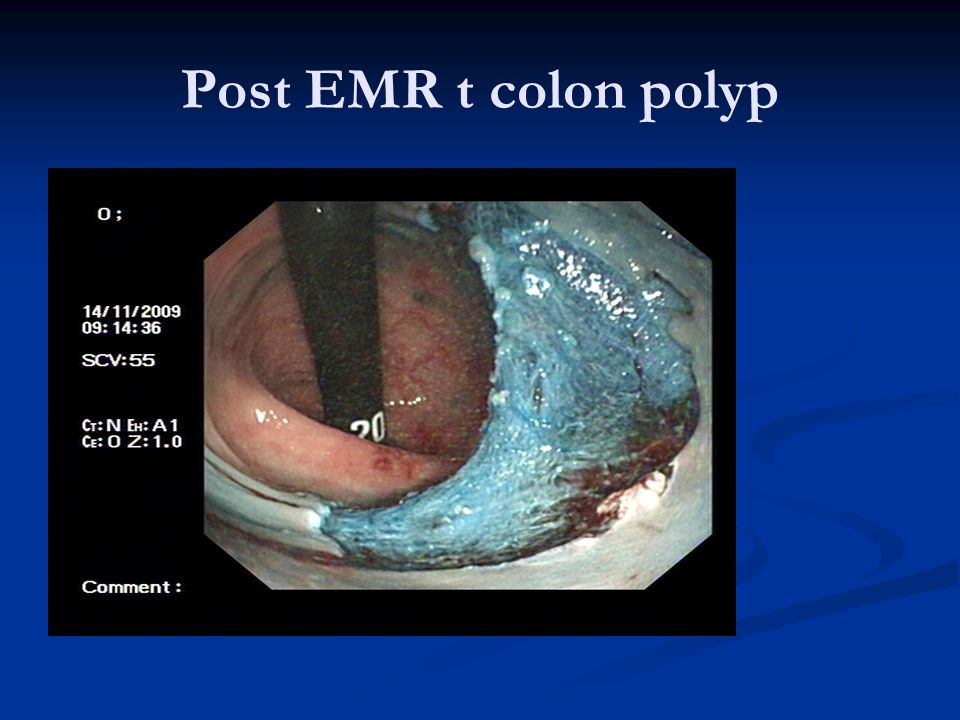 Post EMR t colon polyp