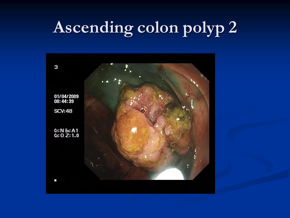 Ascending colon polyp 2