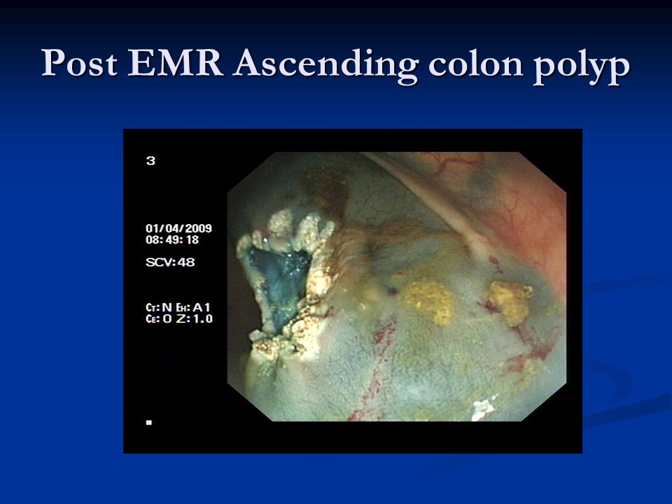 Post EMR Ascending colon polyp